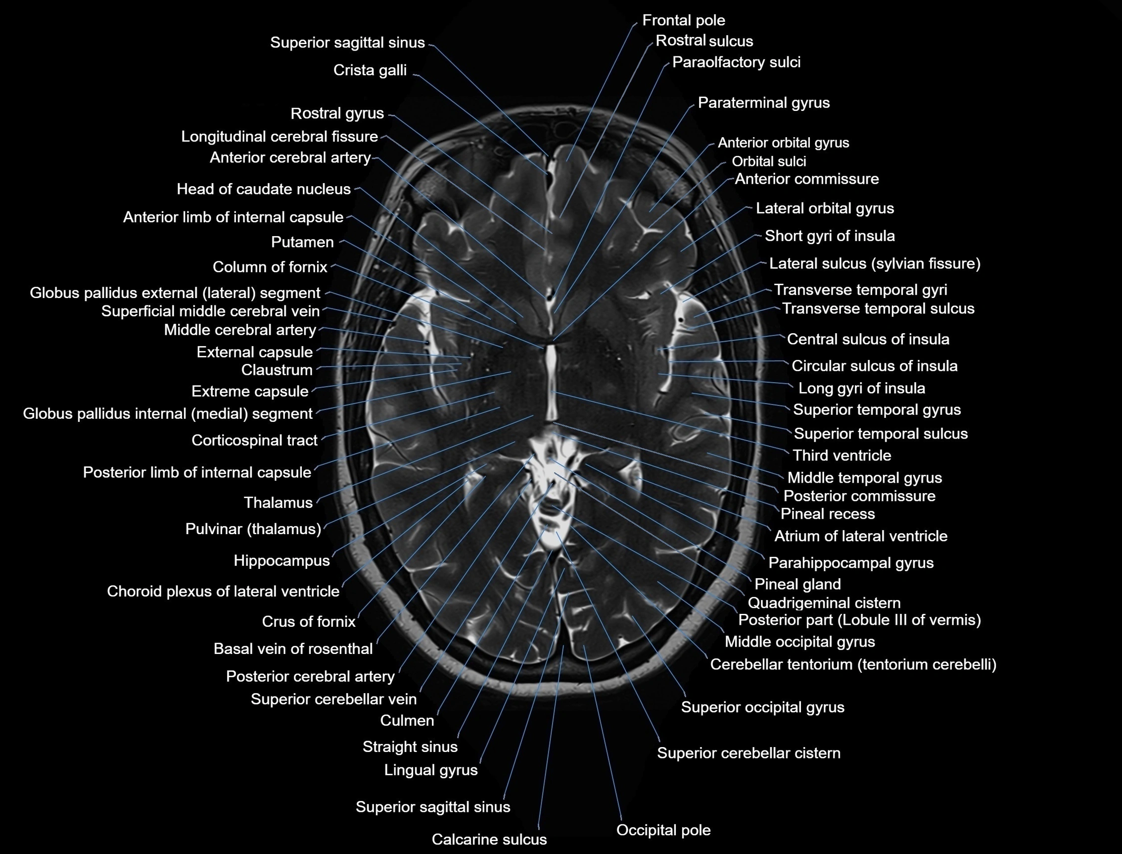 MRI Brain axial cross sectional radiology anatomy 3T image  -img-00001-00027.webp